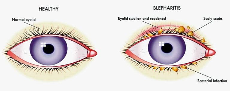 Blepharitis BlephEx - Airedale Opticians Keighley Crosshills