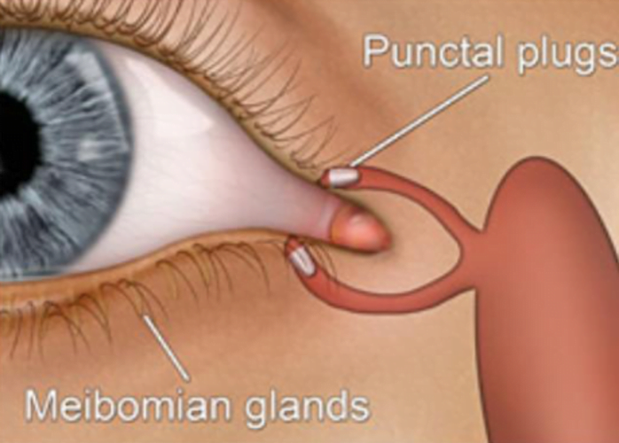 Punctal Plugs