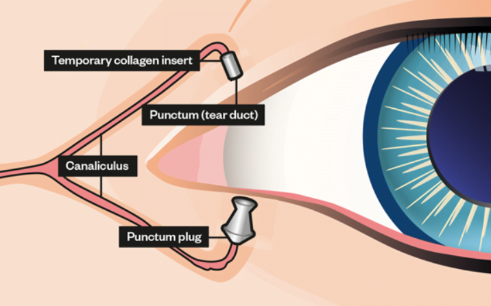 Punctal plugs inserted